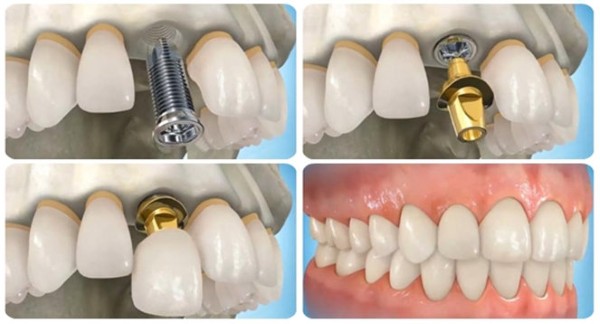 Phương pháp trồng răng Implant