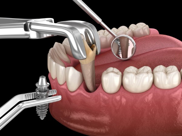 Các yếu tố quyết định sau khi nhổ răng bao lâu thì trồng implant