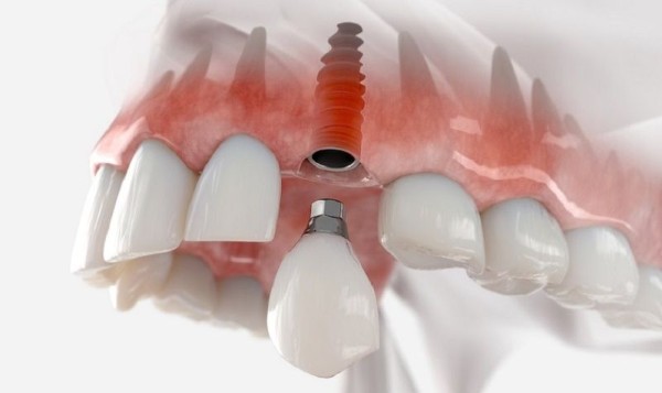 Ưu nhược điểm của các mốc thời gian trồng Implant sau nhổ răng
