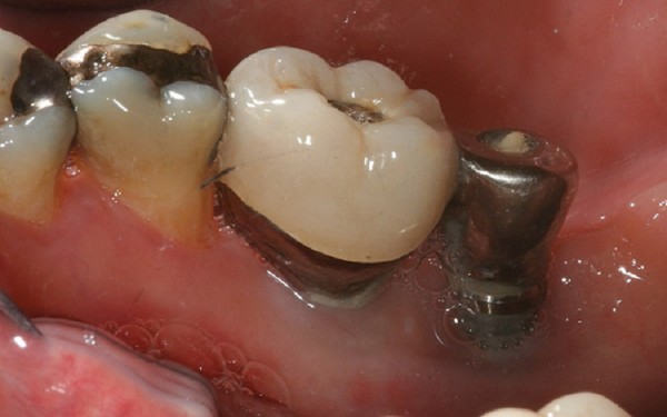 Các rủi ro, biến chứng khi trồng implant không đúng thời điểm
