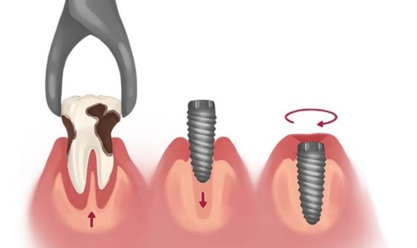 Các câu hỏi thường gặp về vấn đề sau khi nhổ răng bao lâu thì trồng implant