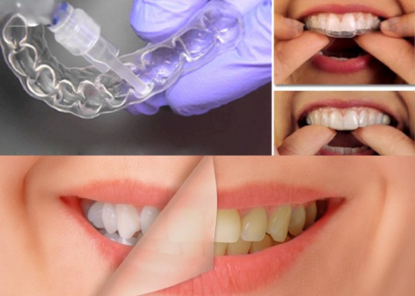 Tẩy trắng răng là quy trình sử dụng hóa chất làm sáng màu răng