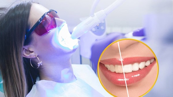 Các giai đoạn cần  kiêng cữ sau khi tẩy trắng răng