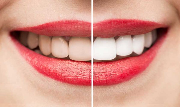 Lưu ý quan trọng và các câu hỏi thường gặp về tẩy trắng răng kiêng gì