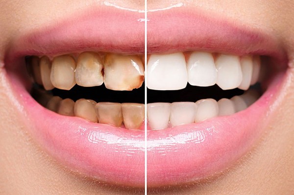Tẩy trắng răng là quá trình loại bỏ vết ố trên bề mặt men răng