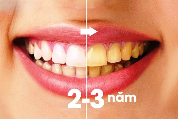 Sau khi tẩy trắng răng có thể bị vàng lại sau vài tháng đến vài năm
