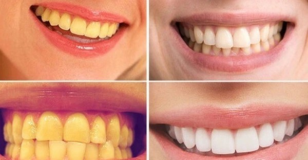 Các thắc mắc thường gặp liên quan đến việc tẩy trắng răng xong bị vàng lại