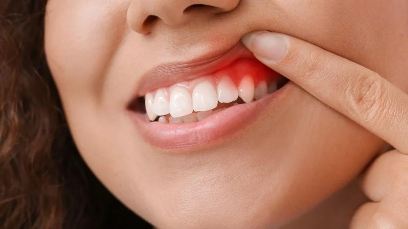 Sưng nướu răng có tự hết hay không?