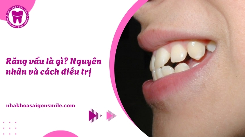 Răng vẩu là gì? Nguyên nhân và cách điều trị