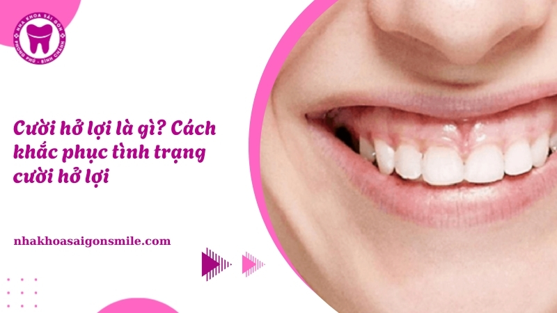 Cười hở lợi là gì? Cách khắc phục tình trạng cười hở lợi