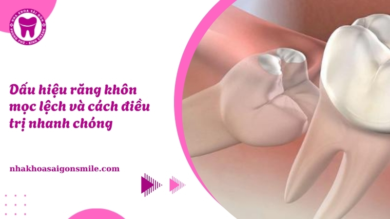 169. Dau hieu rang khon moc lech va cach dieu tri nhanh chong