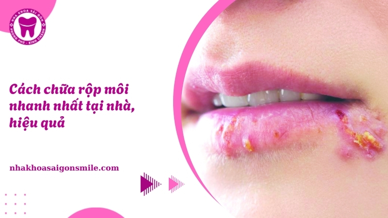 Cách chữa rộp môi nhanh nhất Hướng dẫn chi tiết từ chuyên gia