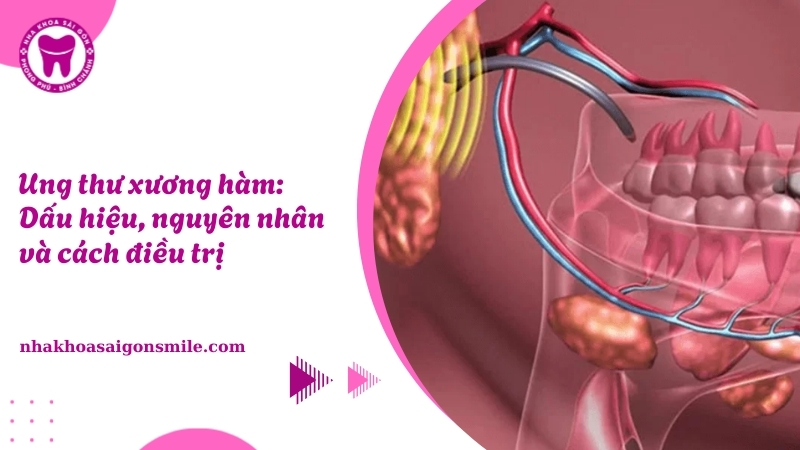 Ung thư xương hàm: Dấu hiệu, nguyên nhân và cách điều trị