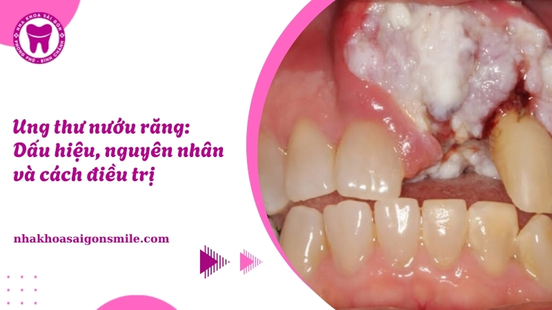 Ung thư nướu răng: Tổng quan và thông tin cần biết