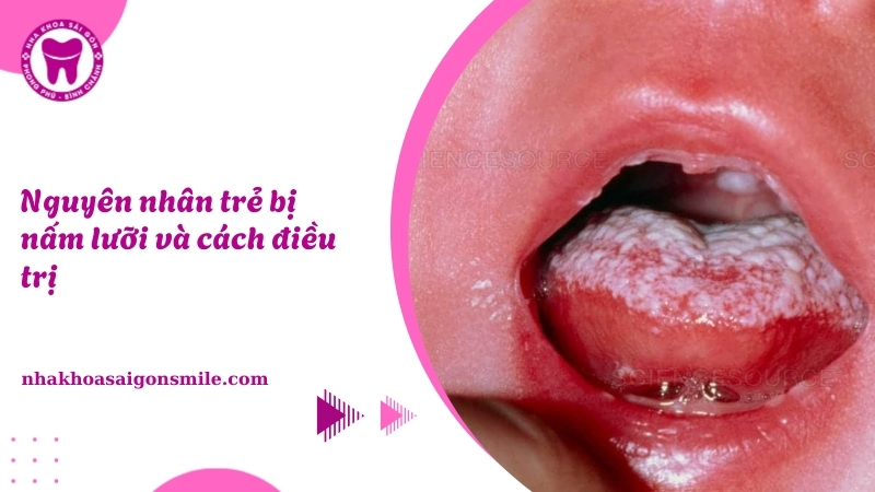 Nguyên nhân trẻ bị nấm lưỡi và cách điều trị hiệu quả