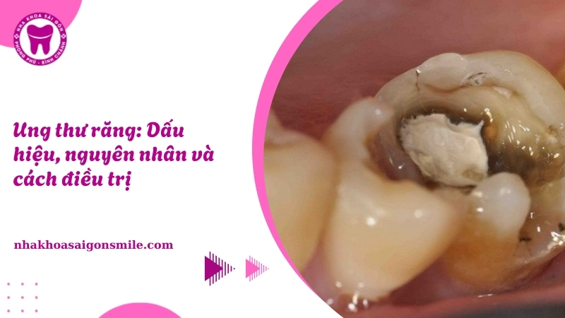 Ung thư răng: Dấu hiệu, nguyên nhân và cách điều trị toàn diện