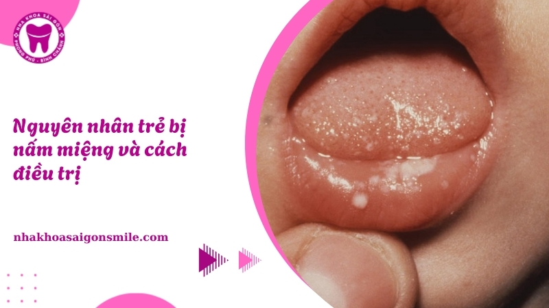 Trẻ bị nấm miệng: Nguyên nhân, nhận biết và cách điều trị hiệu quả