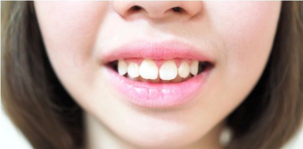 Nguyên nhân dẫn đến răng vẩu là gì?