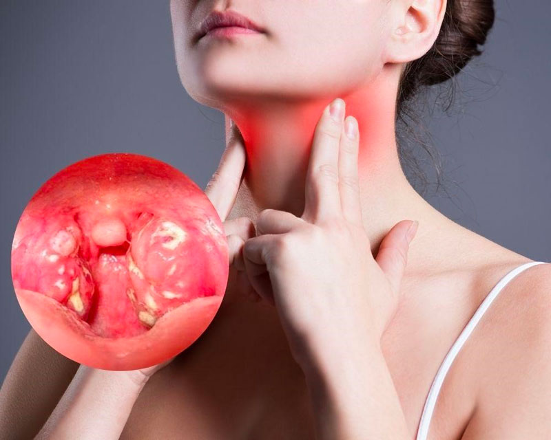 Ăn gì tốt nhất khi bị đau họng?