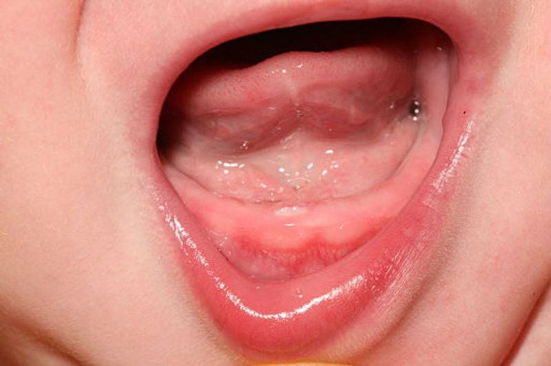 Nướu sưng đỏ, nhạy cảm