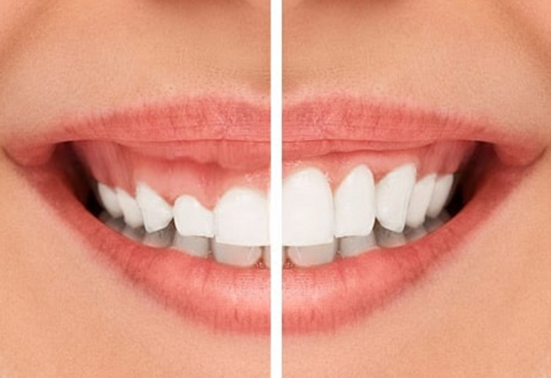 Phẫu thuật cắt nướu