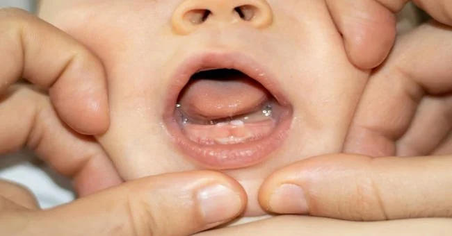 Chồi răng xuất hiện dưới nướu