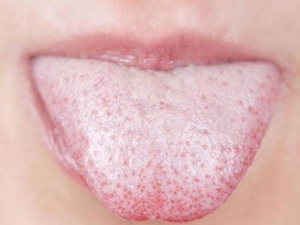 Lưỡi trắng là bệnh gì? 