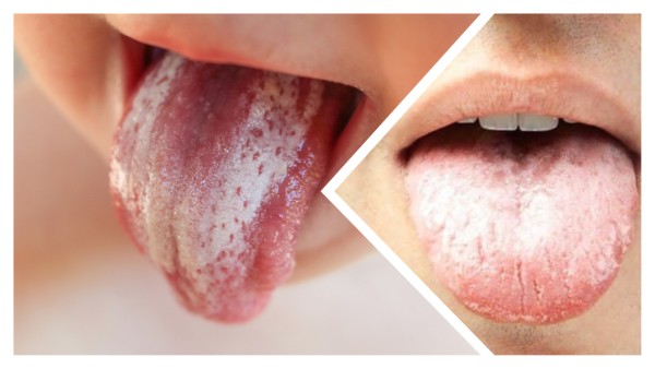 Hiện tượng lưỡi trắng có thể xảy ra ở nhiều nhóm đối tượng khác nhau