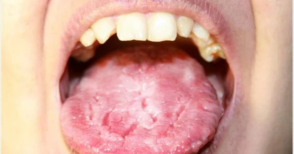Các biểu hiện đi kèm tình trạng lưỡi trắng