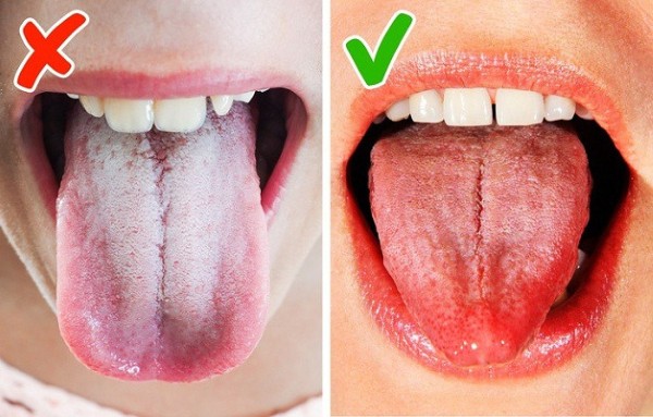 Cách chẩn đoán và phân biệt lưỡi trắng
