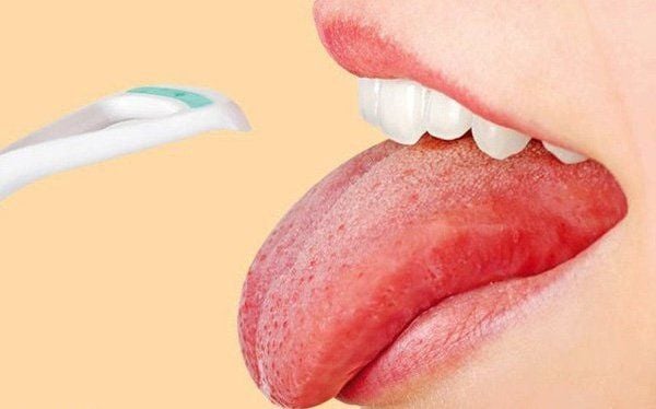 Cách điều trị và phòng ngừa bệnh lưỡi trắng