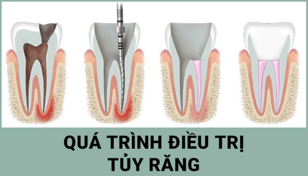 Răng chết tủy tồn tại được bao lâu? Cách xử lý an toàn 2 Quá trình điều trị tủy răng