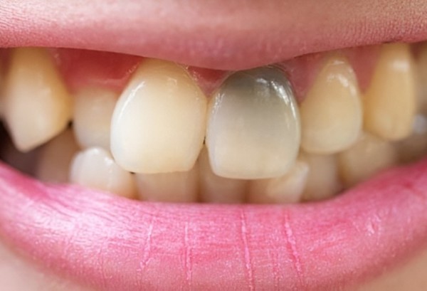 Răng chết tủy tồn tại được bao lâu? Cách xử lý an toàn 3 Răng chết tủy tồn tại được bao lâu?