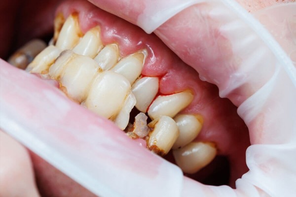 Răng chết tủy tồn tại được bao lâu? Cách xử lý an toàn 4 Các yếu tố ảnh hưởng đến răng chết tủy tồn tại được bao lâu