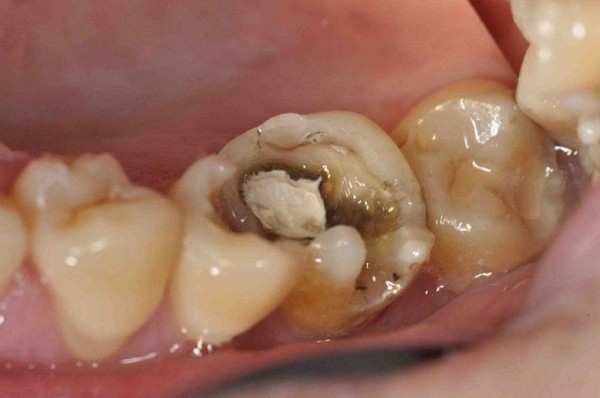 Răng chết tủy tồn tại được bao lâu? Cách xử lý an toàn 5 Các biến chứng tiềm ẩn của răng chết tủy