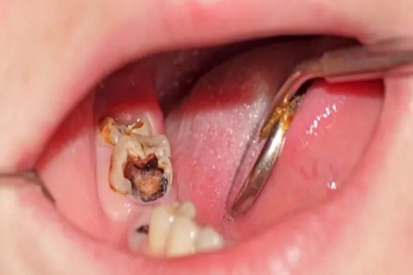 Răng chết tủy tồn tại được bao lâu? Cách xử lý an toàn 6 Những trường hợp cần nhổ răng chết tủy để ngăn ngừa biến chứng