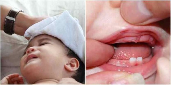 Hiện tượng sốt mọc răng khá phổ biến ở trẻ từ 4 đến 24 tháng tuổi