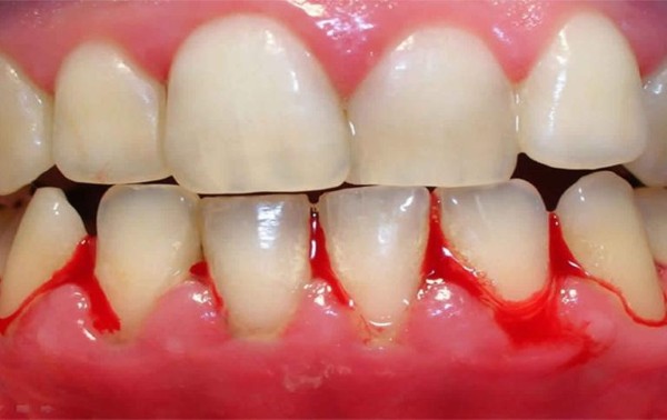 Viêm lợi là là phản ứng viêm xảy ra ở mô nướu