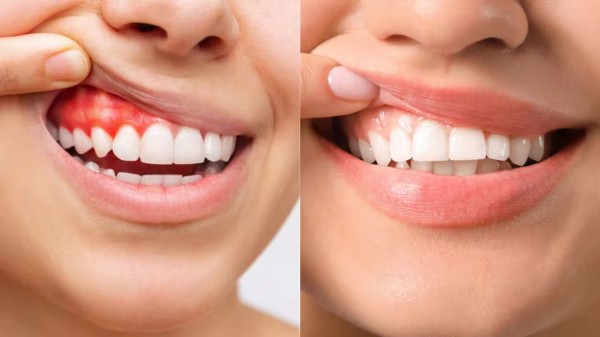 Những lưu ý đặc biệt trong khi điều trị viêm lợi