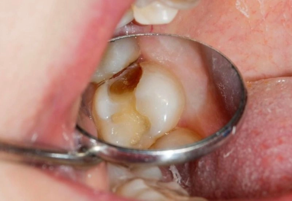 Tình trạng viêm tủy răng có mủ