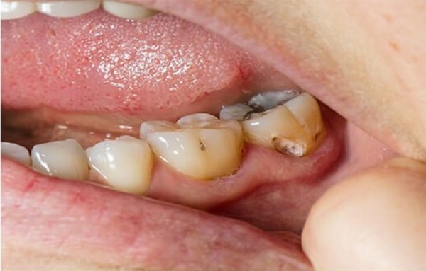 Nguyên nhân và các yếu tố dẫn đến viêm tủy răng có mủ