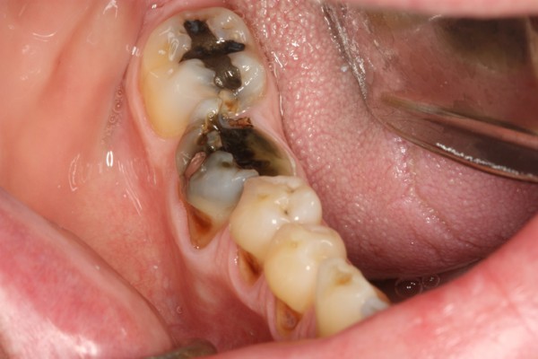 Các biến chứng của viêm tủy răng có mủ cần lưu ý
