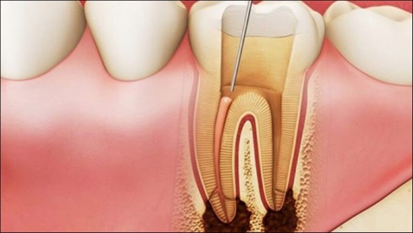 Các phương pháp điều trị viêm tủy răng có mủ