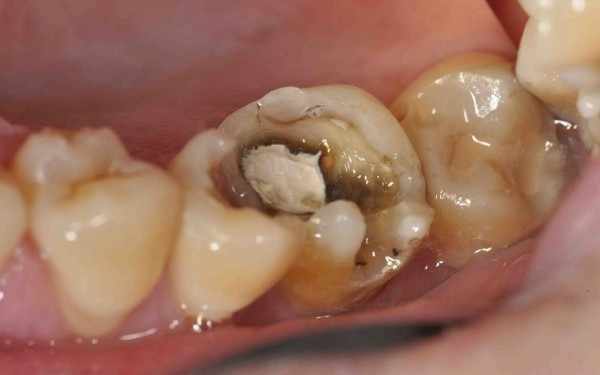 Các câu hỏi thường gặp về viêm tủy răng có mủ