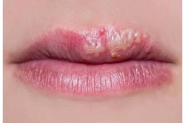 Rộp môi là gì?