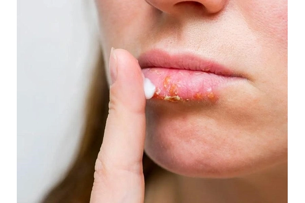 Kem bôi và thuốc mỡ kháng virus lên vùng môi bị rộp