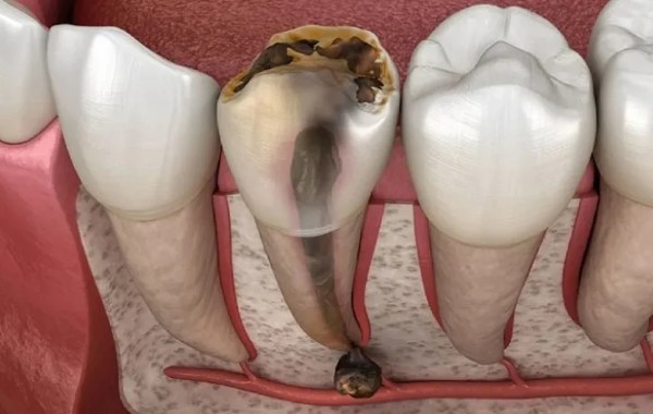 Nguyên nhân khiến tủy răng bị tổn thương hoặc viêm