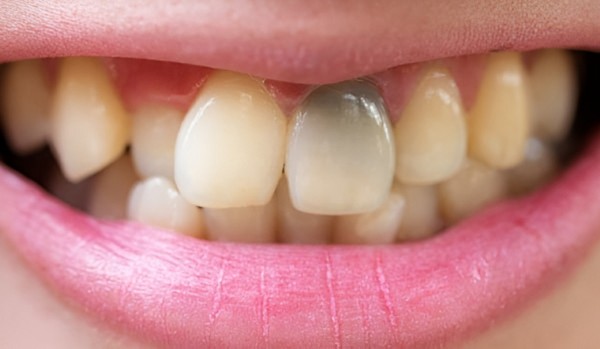 Hiểu đúng về tiêu đề “làm chết tủy răng tại nhà”