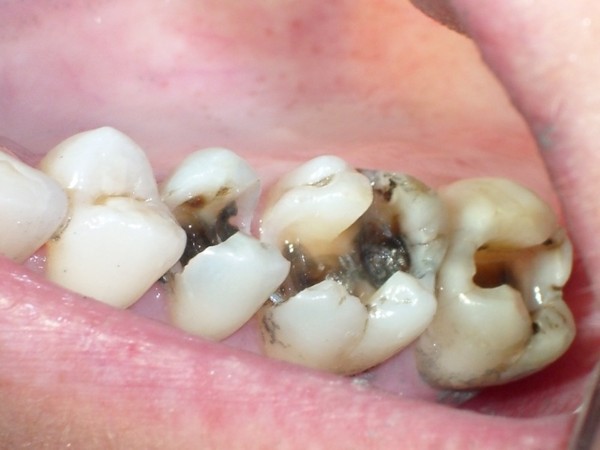 Các dấu hiệu nhận biết khi viêm tủy răng chuyển biến nặng