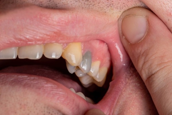 Các câu hỏi thường gặp về cách làm chết tủy răng tại nha